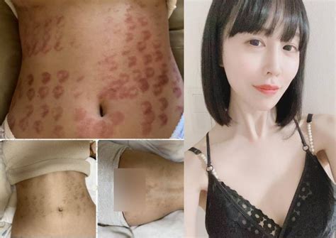 Japanese AV star Riri Hosho reveals she suffered burns across。